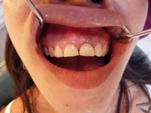 Dental implant London