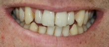 Cosmetic Dentistry Before