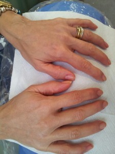 Cosmetic Dentistry Hand Rejuvenation After 2