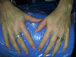 Cosmetic Dentistry Hand Rejuvenation Before
