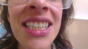 Cosmetic Dentistry Whitening After