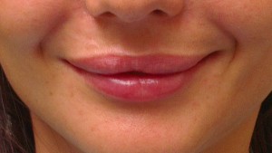 Cosmetic Dentistry Lip Enhancement After