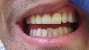 Cosmetic Dentistry Crowns Before