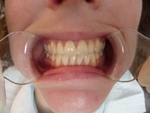 Cosmetic Dentistry Whitening Before