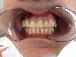 Cosmetic Dentistry Crowns After