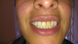 Cosmetic Dentistry Whitening Before