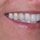 Before and After Dental Implants