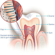 Professional Teeth whitening diagram