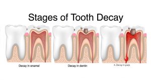 Types of Dental Decay