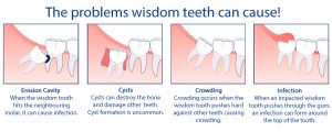 Wisdom teeth extractions