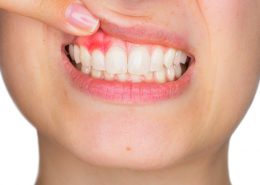 How to stop bleeding gums