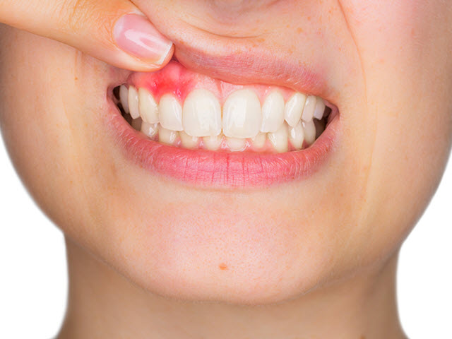 Image result for bleeding gums