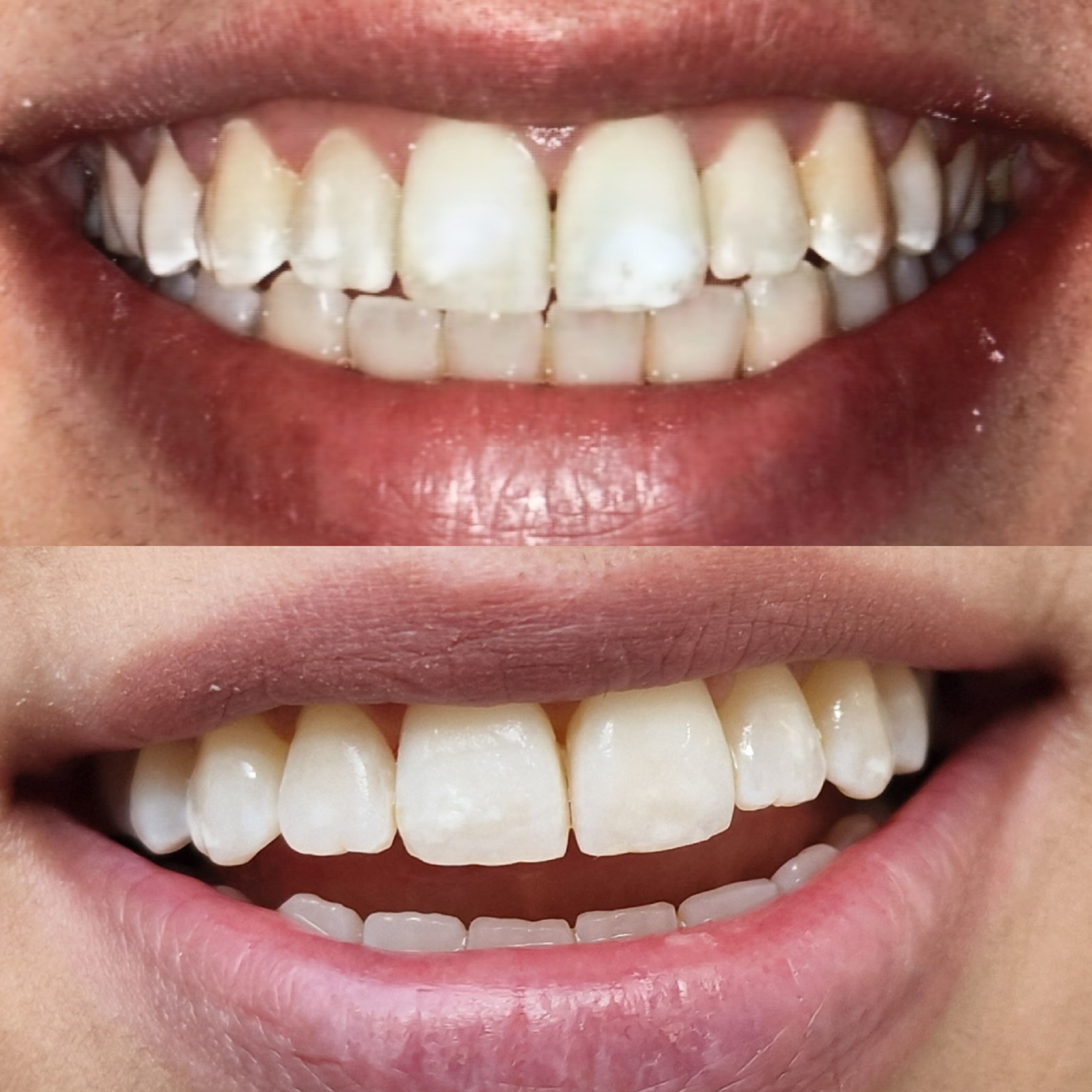 Dental White Spots