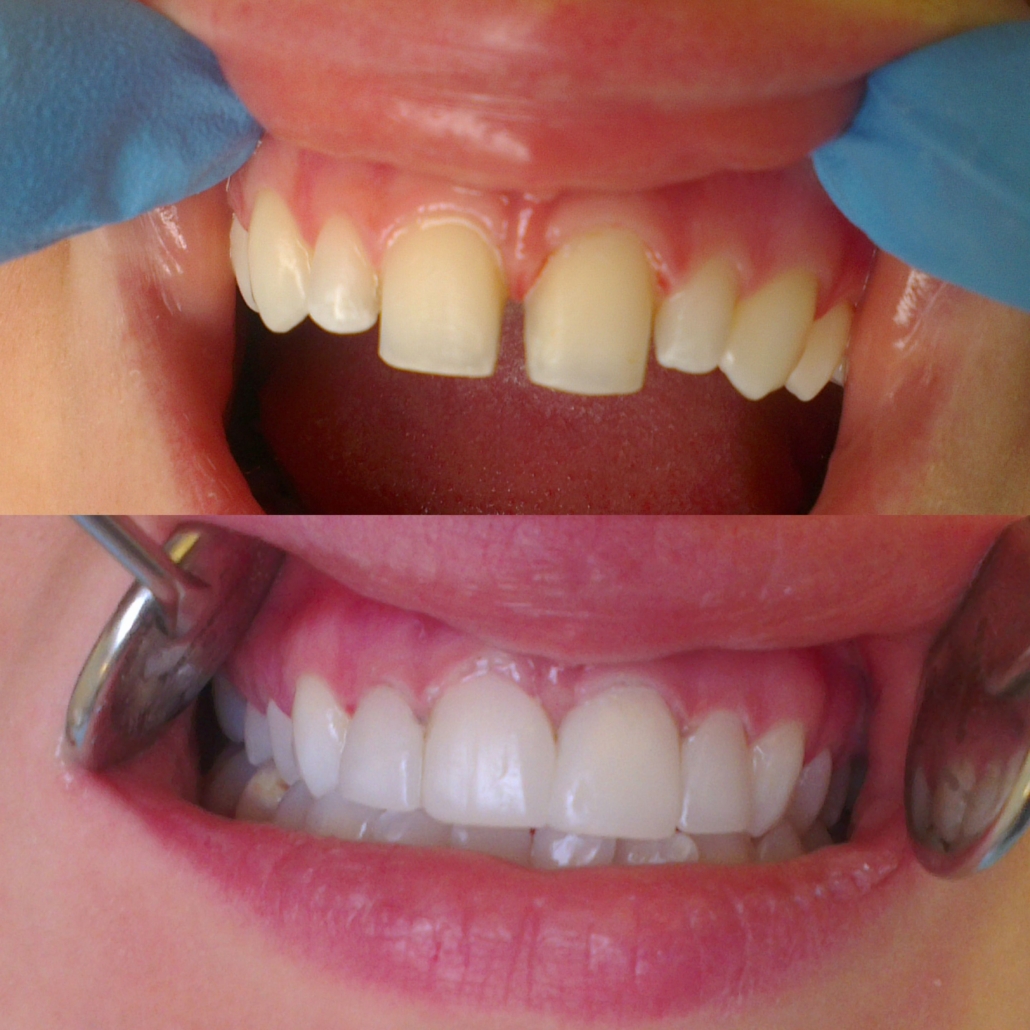 Benefits of Composite Bonding or White Filling - London Specialist