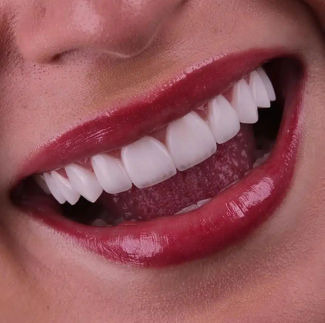 Smile Makeovers in Marylebone